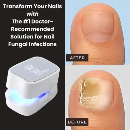 Before and after fingernail fungus treatment using ClearNail Pro laser device, showing visibly clearer and healthier nails